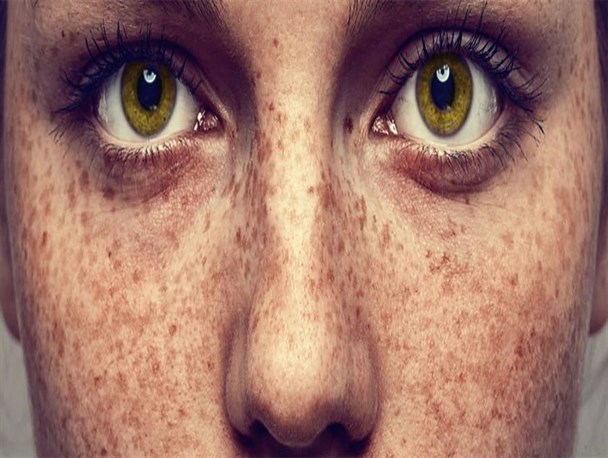 مهمترین درمان کک و مک، ضد آفتاب است/ ارائه نسخه‌های خانگی موثر برای رفع این عارضه پوستی