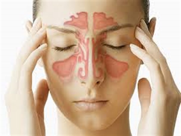 مهمترین علامت سینوزیت، ترشحات چرکی است