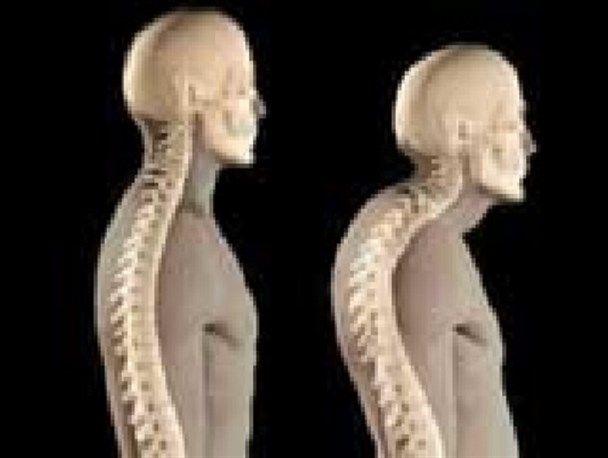 عارضه گرد پشتی را جدی بگیریم