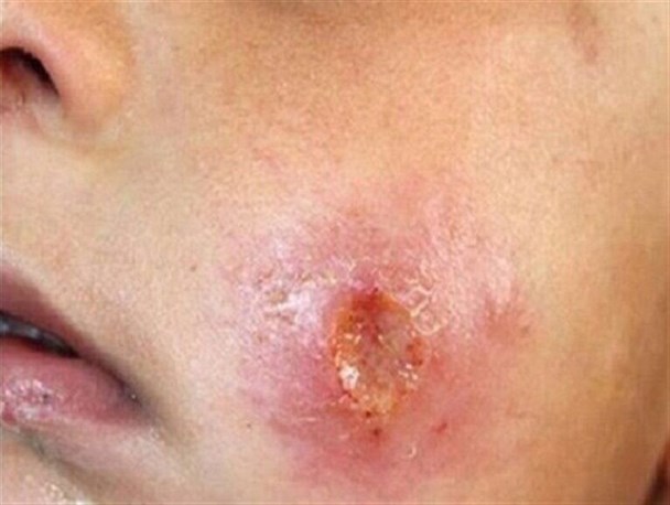 اقدامات پوپولیستی معضل "سالَک" را حل نمی‌کند/ بودجه ۵۰ میلیاردی مهار بیماری سالک هرگز به دست دهیاری‌ها نرسید