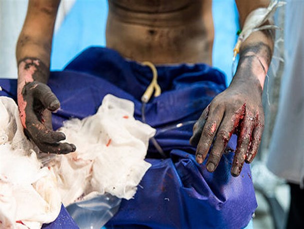 چهارشنبه سوری با طعم گوشت سوخته!/ اقدامی که به قیمت هزینه‌های گزاف درمان تمام می‌شود