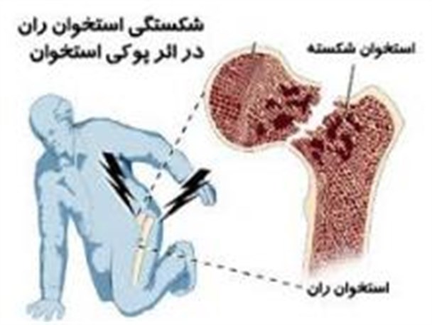 تغذیه مناسب و ورزش از بروز پوکی استخوان جلوگیری می کند