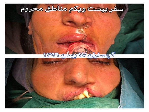 ویزیت رایگان بیش از ۱۲۵۰ نفر عارضه شکاف لب و کام در بهمن امسال/ سال آینده عارضه شکاف لب و کام در کهگیلویه و بویراحمد ریشه کن می شود