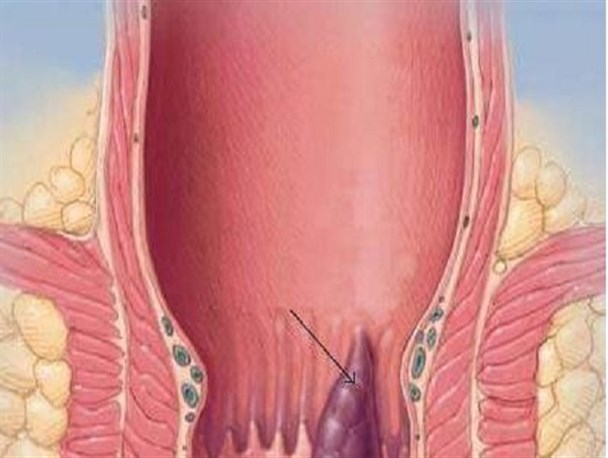 روش های درمان بواسیر  چیست؟