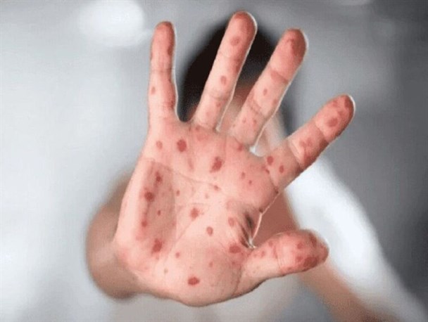 جزئیات تازه از زوج مبتلا به آبله میمونی در خوزستان
