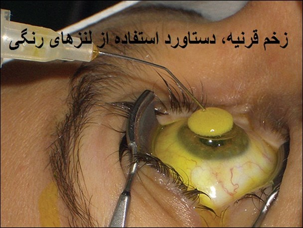 زخم قرینه دستاورد استفاده از لنزهای رنگی/ از تهدید سلامت شهروندان تا فروش غیربهداشتی لنز در زاهدان