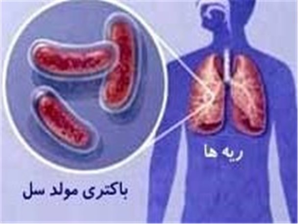 کرمانشاه قطب منطقه غرب در تشخیص بیماری سل است/ ارائه خدمات رایگان به بیماران مسلول