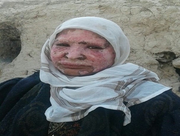 بیماری ناشناخته ای که به دلیل فقر درمان نشد/ بیماران تحت پوشش کمیته امداد نیازمند حمایت بیشتر