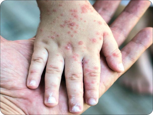 چگونگی برگشت سرخک به کشور با وجود ریشه‌کنی/ شیوع سرخک در کشورهای همسایه ایران؛ تهدیدی برای سلامت مردم