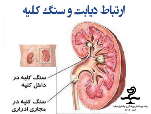 شایعترین علت نارسایی کلیه ها، ابتلاء به دیابت است/دفع آلبومین؛ اولین علامت گرفتاری کلیه ها در دیابت