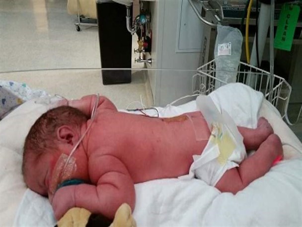 درمان رایگان ۲۲۰ نوزاد مبتلا به بیماری‌های مادرزادی نخاع