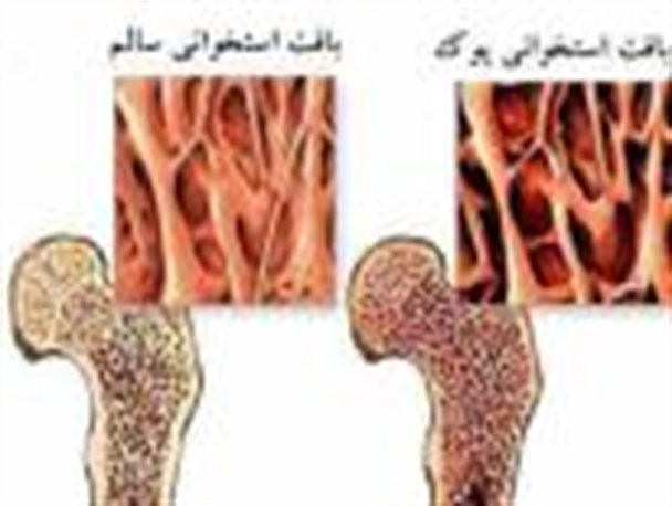 بیماری پوکی استخوان را بیشتر بشناسیم
