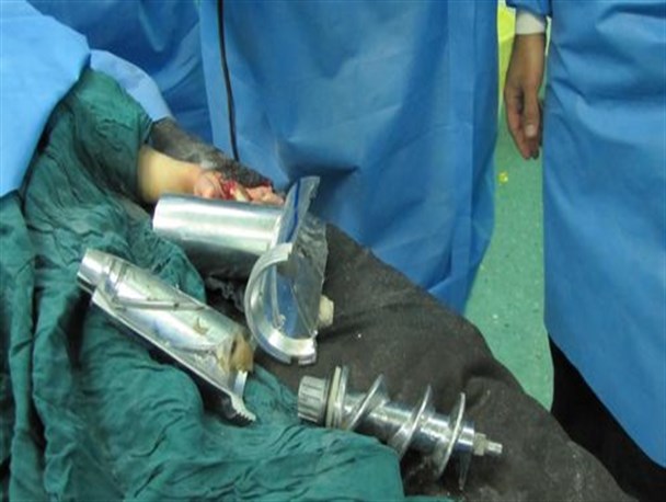 گیر کردن دست کودک 3 ساله سقزی در چرخ گوشت +عکس