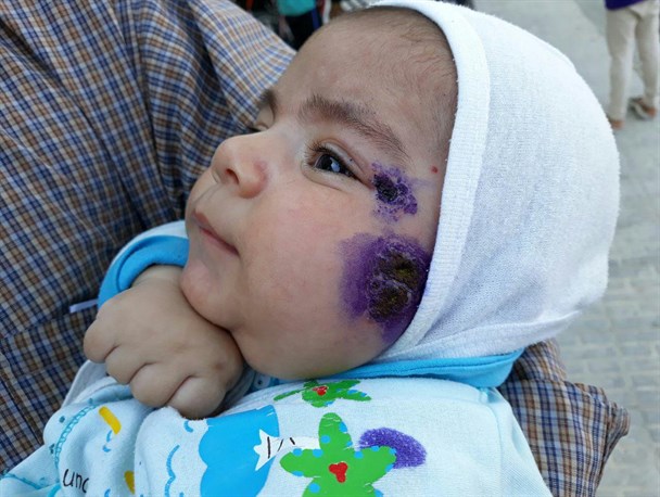 ابتلای سه هزار نفر به سالک در شرق اصفهان/ روستایی هزار نفری با 300 آمار مبتلا