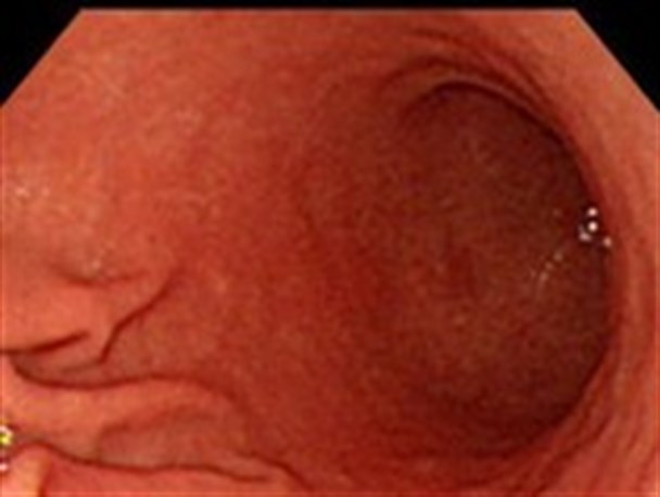 استرس شدید و مصرف زیاد نمک از عوامل سرطان معده