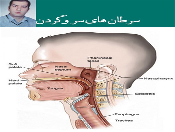 ابداع یک روش جدید برای درمان خشکی دهان مبتلایان به سرطان سر و گردن